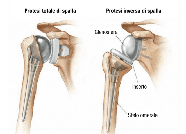 Spalla con protesi anatomica e protesi inversa