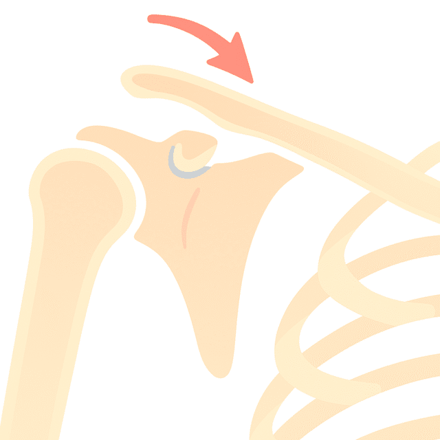 Lussazione Acromion clavicolare